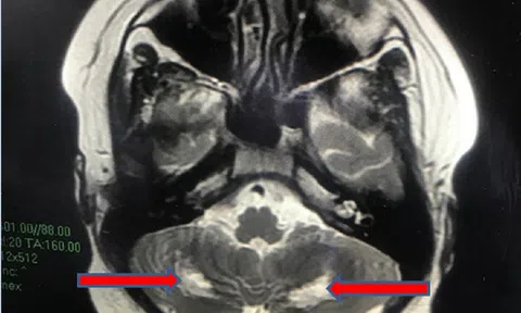 Bé trai 13 tuổi bị tổn thương não hậu COVID-19