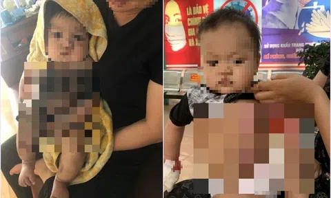 Bé 6 tháng tuổi bị nhiễm trùng vì gia đình đắp thuốc nam chữa bỏng