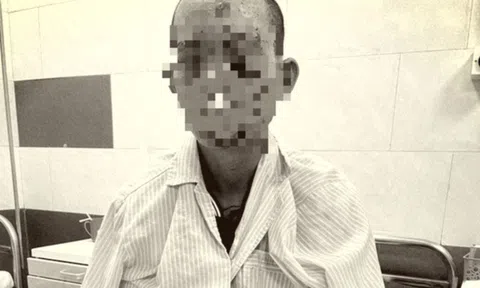 Dùng diện thoại khi đang sạc, nam thanh niên bị cháy sém toàn thân, nguy cơ mù mắt