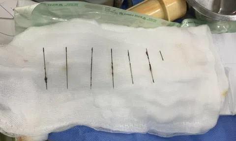 Người phụ nữ tự đâm 7 cây kim vào ngực vì bị stress