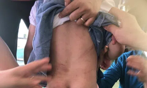 Vụ dì ruột dùng chổi sắt đánh bé 4 tuổi: Nạn nhân thương tích 9%