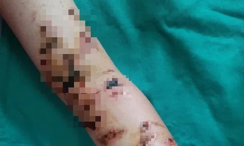 Tin tức đời sống ngày 12/5: Cơ thể bé trai 10 tuổi đầy vết thương vì bị sứa đốt