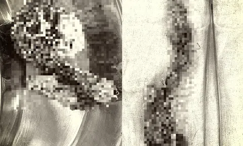 Tin tức đời sống ngày 13/5: Bé gái nhập viện cấp cứu vì búi tóc lớn trong dạ dày