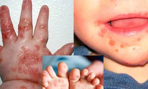 Một ca tử vong vì dịch tay chân miệng, Bộ Y tế cảnh báo