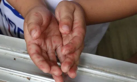 Bác sĩ chỉ ra dấu hiệu cảnh báo trẻ em mắc tay chân miệng trở nặng