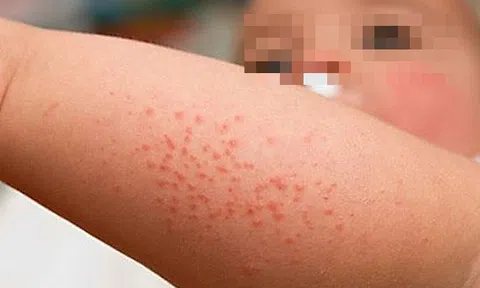 Hai bệnh nhi nguy kịch vì sốt xuất huyết, bác sĩ đưa ra lời khuyên quan trọng