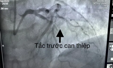 Cứu sống bệnh nhân quốc tịch Mỹ nhồi máu cơ tim cấp nguy kịch