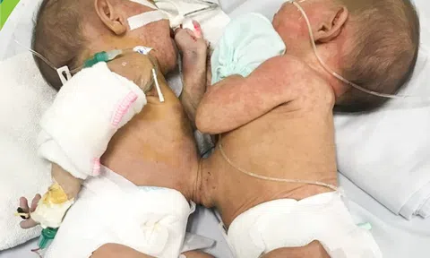 Cặp song sinh dính liền hiếm gặp, tỷ lệ 1/200.000