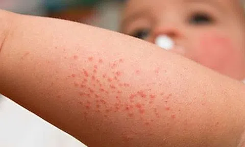 TP.HCM: Sốt xuất huyết tiếp tục leo thang, thêm 111 ổ dịch mới