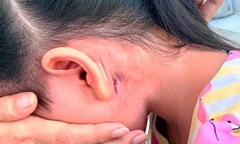 Nữ sinh ở Đắk Lắk được phát hiện mắc bệnh "vi khuẩn ăn thịt người"
