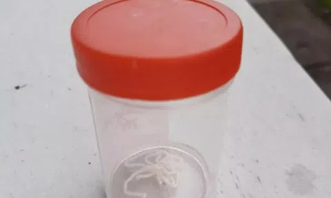 Kéo giun dài 8cm ra từ tay của người đàn ông “nghiện” ăn gỏi cá