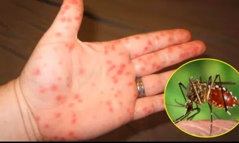 22 người tử vong vì sốt xuất huyết, Bộ Y tế cảnh báo