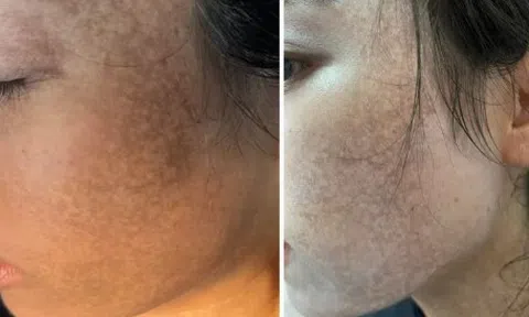 Mặt cô gái "cháy đen" vì lăn kim, lột da tại spa