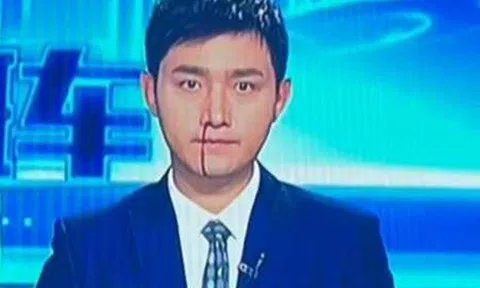 Đang dẫn chương trình thời sự, nam MC bất ngờ bị chảy máu mũi và màn xử lý xuất sắc