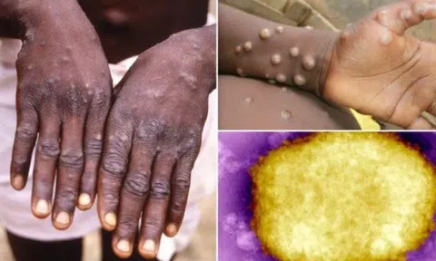 Bộ Y tế khuyến cáo cách phòng, chống bệnh đậu mùa khỉ