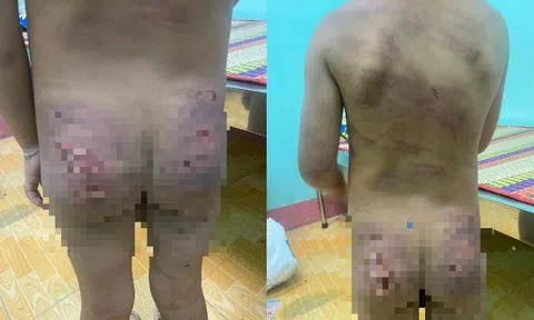 Vụ bé gái 7 tuổi chi chít vết thương: Bị mẹ và cha dượng đánh?