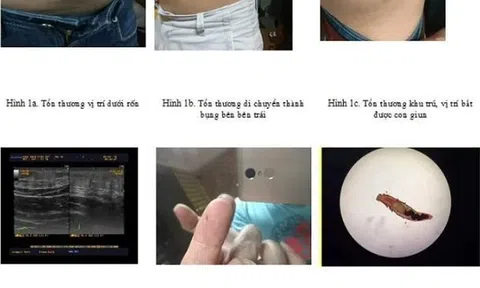 Thường xuyên ăn ếch nướng, chàng trai bị "vật thể lạ" làm tổ ở vùng kín