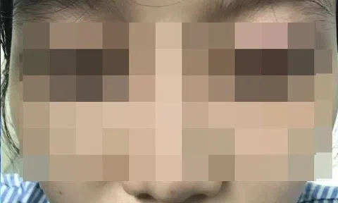 Cắt mí ở thẩm mỹ viện "chui", người phụ nữ bị thủng 4 lỗ trong mắt