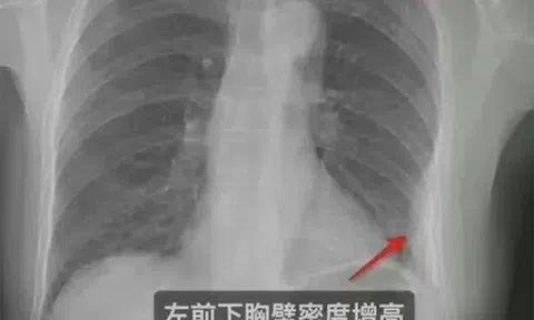 Đau đớn sau cái ôm của đồng nghiệp, cô gái nhận kết quả gây sốc khi đến bệnh viện kiểm tra