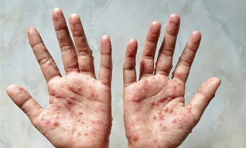 Khánh Hòa giám sát chặt bệnh đậu mùa khỉ tại cửa khẩu, trong cộng đồng