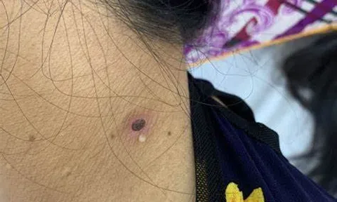 Liên tiếp phát hiện các trường hợp bị sốt mò, cần ghi nhớ những điều này để phòng bệnh
