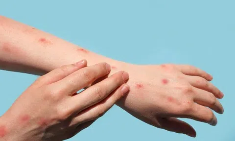 Lý do WHO kêu gọi đổi tên bệnh đậu mùa khỉ