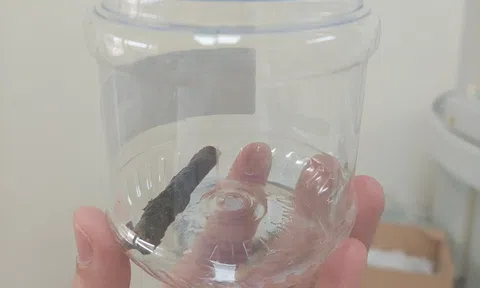Ho ra máu suốt 14 năm, hóa ra bị cành cây dài gần 7cm đâm xuyên phổi