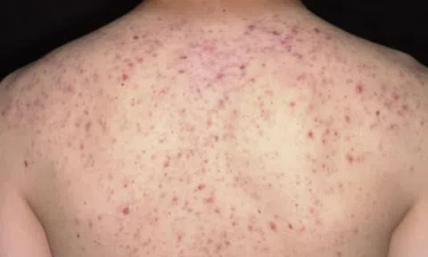 Người phụ nữ 36 tuổi suýt mất mạng vì đến spa trị mụn trứng cá ở lưng