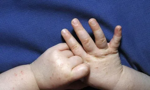 Chuyên gia chỉ cách phòng tránh đậu mùa khỉ ở trẻ em