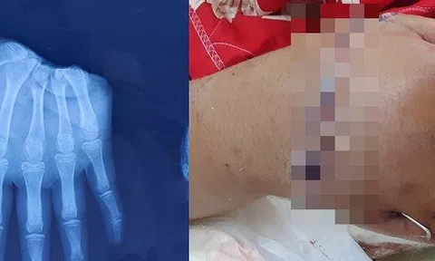 Nối thành công bàn tay đứt lìa cho bé trai 12 tuổi