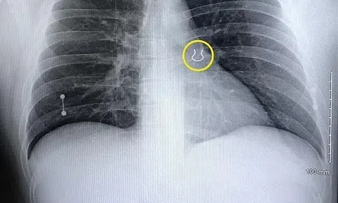 Người đàn ông nhập viện vì ho dữ dội, ảnh chụp X-quang tiết lộ điều khó tin