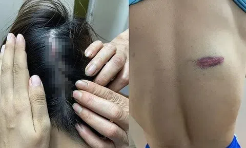 Điều tra vụ vận động viên đấu kiếm bị đồng đội hành hung nhập viện