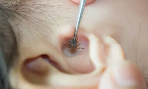 Phát hiện ve chó còn sống trong tai bé gái 2 tuổi