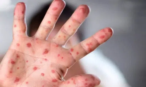 Bộ Y tế thông tin về bệnh nhân đầu tiên mắc Đậu mùa khỉ tại Việt Nam