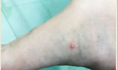 Bệnh nhân mắc đậu mùa khỉ đầu tiên ở Việt Nam hiện ra sao?