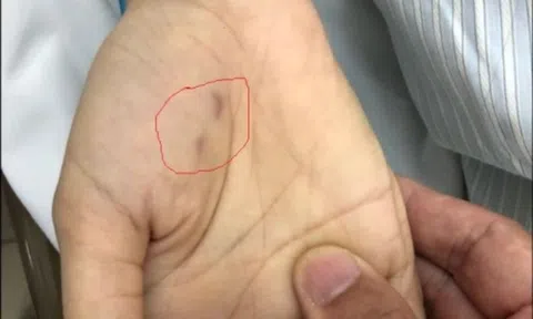 Nữ bác sĩ thú y tử vong vì vết cắn nhỏ xíu của thú cưng trên tay