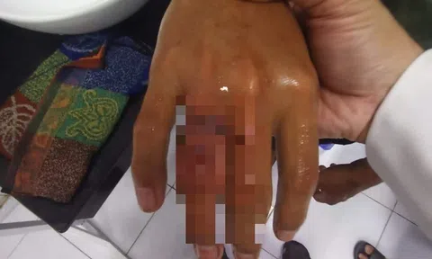 Tin tức đời sống ngày 13/10: Ngón tay sưng tấy sau 1 ngày đeo nhẫn giá rẻ mua trên mạng