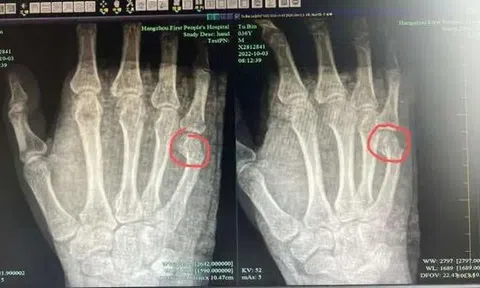 Bố bị gãy xương tay vì làm hành động này trong lúc dạy con học