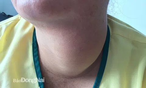 Tin tức đời sống ngày 18/10: Phẫu thuật bóc tách bướu cổ nặng gần 1kg cho nữ bệnh nhân