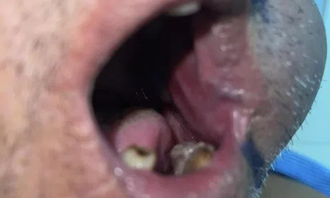Ngạt tắc mũi tăng dần cảnh giác ung thư vùng mũi xoang