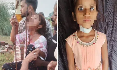 Bác sĩ nỗ lực cứu bé gái 8 tuổi bị thanh sắt đâm xuyên cằm