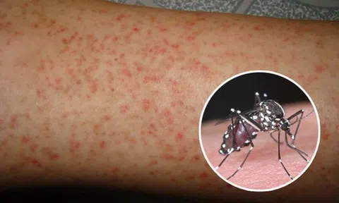 3 món ăn hỗ trợ người bệnh sốt xuất huyết phục hồi tốt