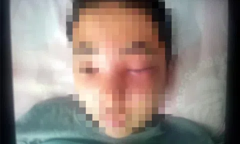 Bé trai nặn mụn dẫn đến viêm màng não, bác sĩ cảnh báo về vùng tam giác nguy hiểm