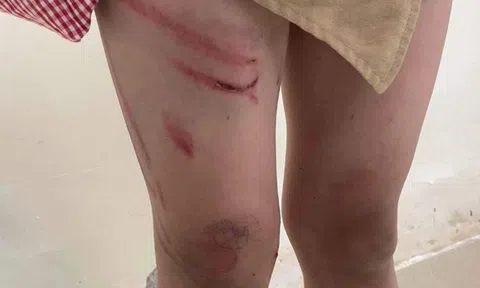 Hải Phòng: Bé trai 8 tuổi nghi bị cha dượng "hờ" đánh bầm tím khắp người