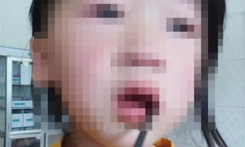 Bé gái 4 tuổi bị thanh thép dài 20cm đâm xuyên miệng trong lúc vui đùa