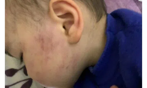 Bé trai 2 tuổi bị tát sưng một bên má ở Thái Bình: Cô giáo nói bé "ngã vào rổ đồ chơi"