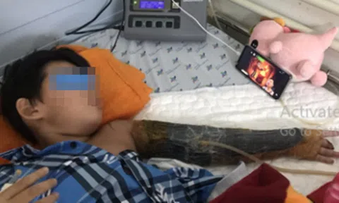 Vào công trình xây dựng chơi, cháu bé bị máy trộn bê tông làm dập nát cánh tay