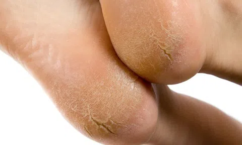 4 cách bảo vệ sóc gót chân khô, nứt nẻ trong mùa đông
