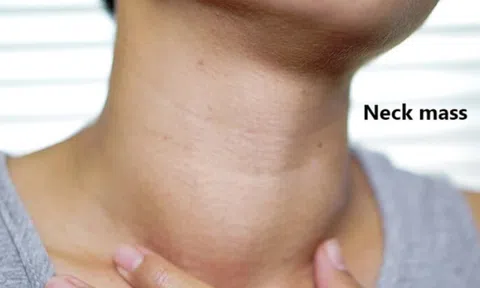 Thấy 3 dấu hiệu lạ này ở cổ, coi chừng ung thư tuyến giáp "ghé thăm"
