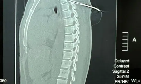 Nam thanh niên bị mũi tên bắn cá dài 7cm đâm xuyên tủy
